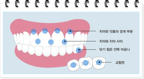 충치 발생하기 쉬운 부분