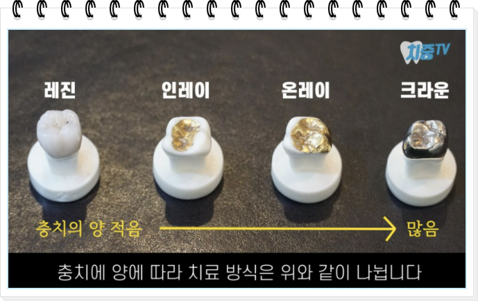 단계별 충치 치료 설명사진. 레진치료, 인레이치료, 온레이 치료, 크라운까지