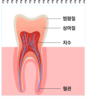 충치 치료를 보여주는 치아 단면
