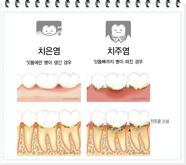 잇몸질환의 두가지, 치은염과 치주염