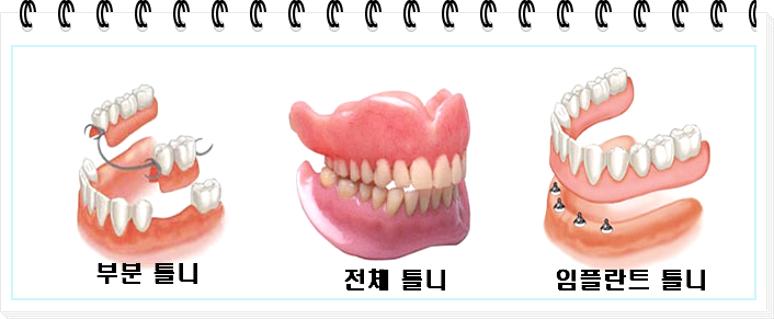 틀니 종류별 가격과 장단점 설명