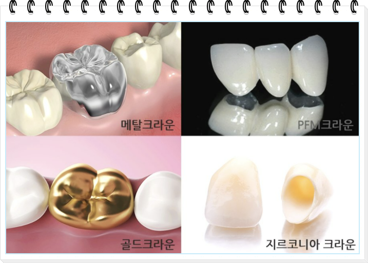 재료별 치아 크라운 종류