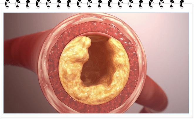고지혈증에 나쁜 음식