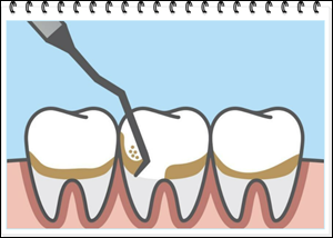치석 제거, 예방