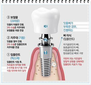 시흥 임플란트 가격 비교 및 치과 추천안내