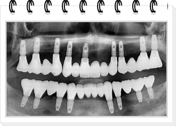 전체 임플란트 갯수 및 후기